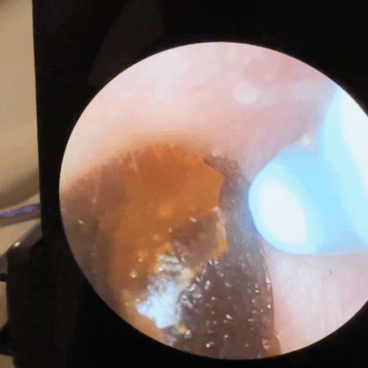 Clirear™ CamPro: La Tecnologia per la salute dell’orecchio approvata dai migliori esperti!